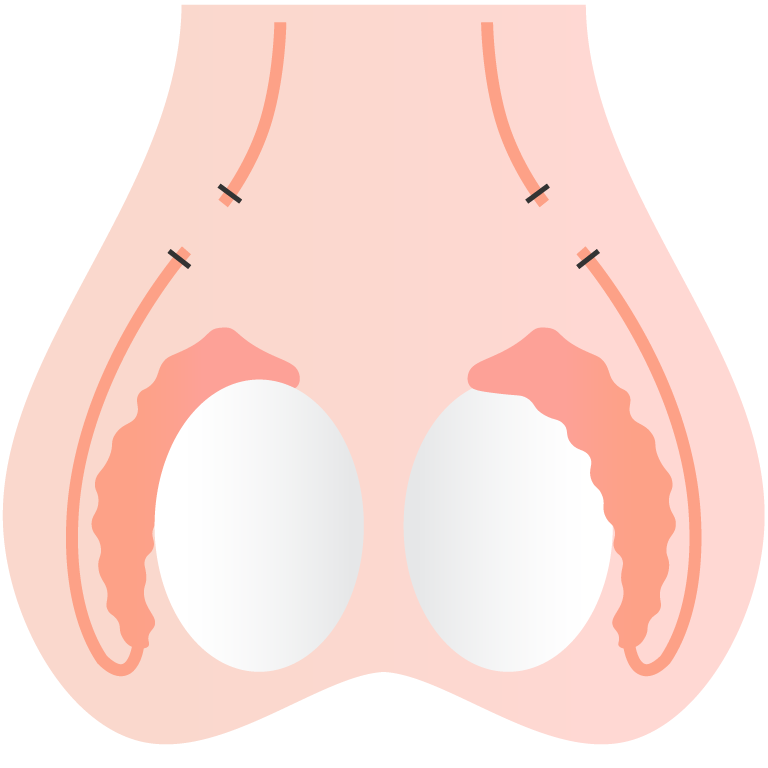 No-Scalpel Vasektomie in Wien